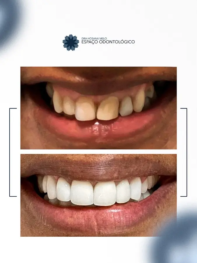Antes e depois de transformação do sorriso realizada no Espaço Odontológico
